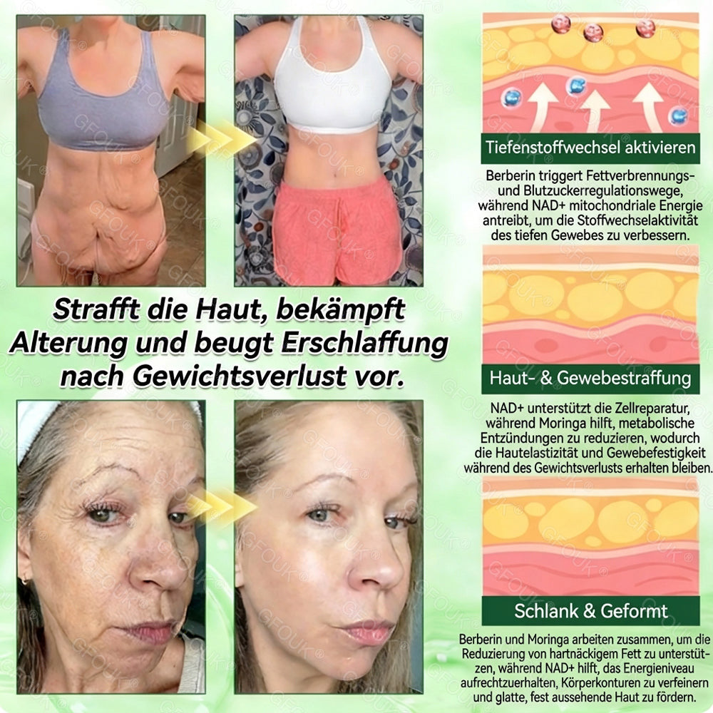 🫣🇩🇪Offizieller Shop | ✅ GFOUK® Moringa Berberinex NAD+ 10-in-1 Nano-Mikronadel-Patch (Nur einmal täglich, sichtbare Veränderungen in 7 Tagen) ✅ Für Übergewicht, lockere Haut, Diabetes, Schlafapnoe, Gelenkprobleme und mehr